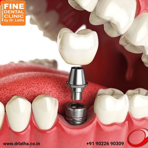 Get your Beautiful Teeth with Dental Implants | Fine Dental Clinic - Dr ...